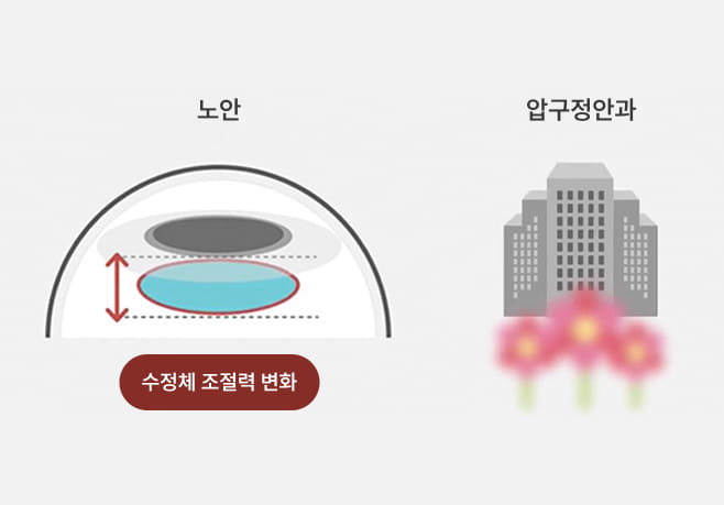 노안